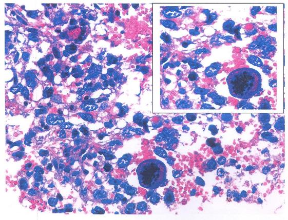 Figure 5: Photomicrograph demonstrating nuclear and cytoplasmicpleomorphism, features of intratumoral hemorrhage and multinucleated giant cells (inset).