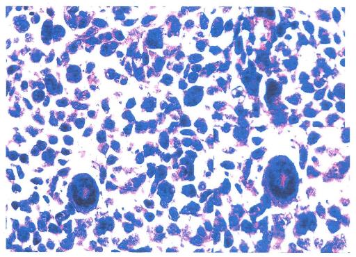 Figure4: Photomicrograph showing a highly cellular tumor with marked nuclear atypia, numerous mitoses and multinucleated giant cells (inset).
