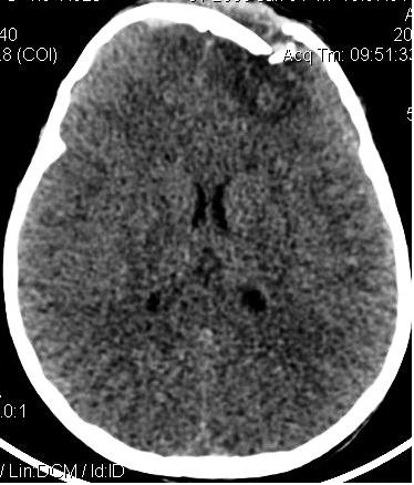 Figure 3 : Scanner cérébral montrant une embarrure frontale gauche