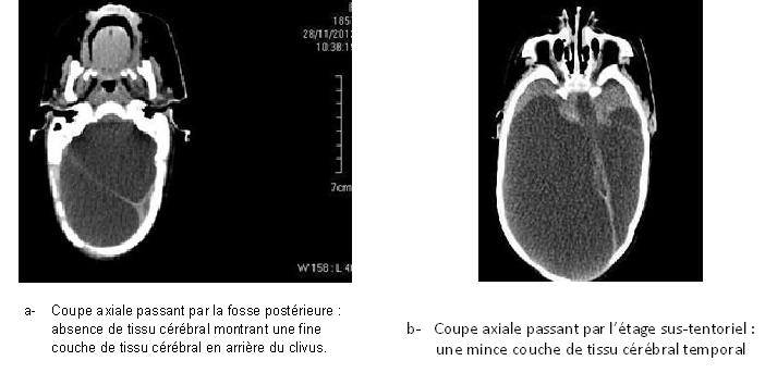 Figure N°1 : scanner cérébral : montrant une hydranencéphalie.