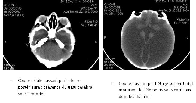 Figure 2 : Scanner cérébral en coupe axiale montrant une hydranencéphalie.