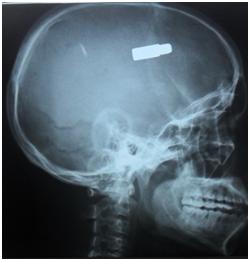 Figure 1 : Radiographie standard du crâne (Profil) réalisée à l'admission du patient, quatre (04) jours après le traumatisme et montrant un projectile en situation fronto pariétale.