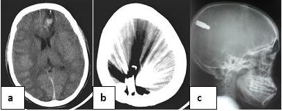 Figure 2 : Coupe axiale au scanner cérébral montrant la porte d'entrée frontale gauche avec un hématome fusiforme (a), une migration en région occipitale droite (b) au 2ème jour d'hospitalisation. Même migration observée à la radiographie standard (c).