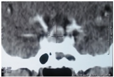 Fig.3 Coronal CT scan showing  typical image of  an intrasellar abscess 