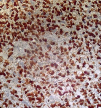 Fig n°4 : Examen immunohistochimique, anticorps anti-myogénie (Clone 5FD, Dako), grossissement x20 : Les cellules tumorales expriment l'anticorps anti-myogénine (expression nucléaire).