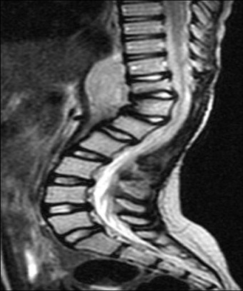 Fig n° 6 : IRM de contrôle en coupe sagittale T2 montre la récidive prévertébrale du processus tumoral en regard de T10-L2. 