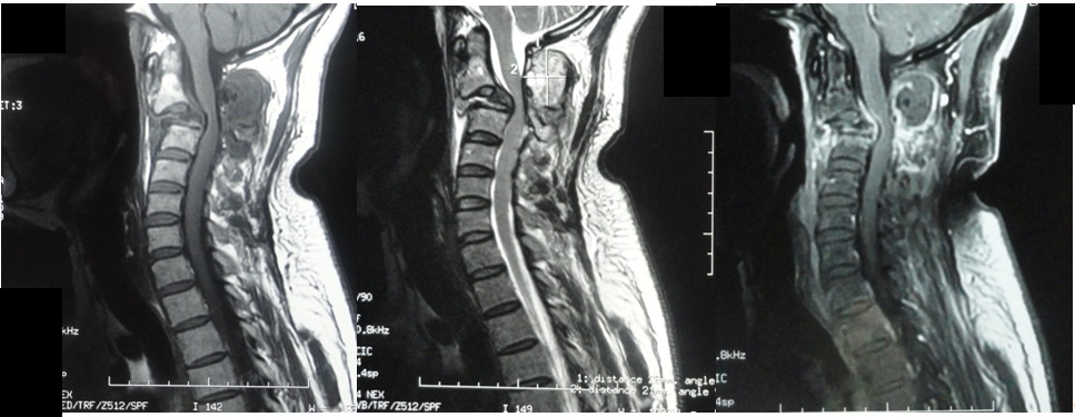 Figure 1 : IRM médullaire en coupe sagittales réalisée en séquences pondérées