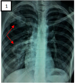 Figure 1: Télé-thorax