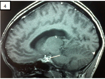 Figure 4 : IRM Encéphalique (T1+Gado sagittale)