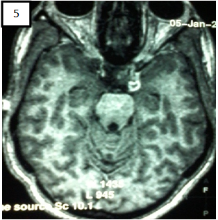 Figure 5: IRM Encéphalique (T1+Gado axiale)