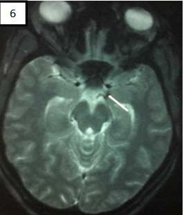 Figure 6 : IRM Encéphalique (T2* axiale)