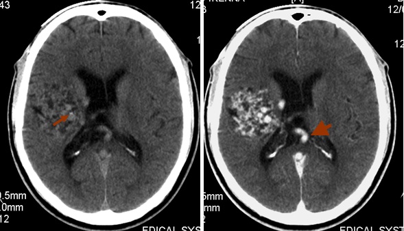 AJNS African Journal Of Neurological Sciences INTRACEREBRAL 