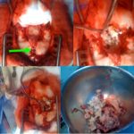 Figure 2: Différents aspects peropératoire d'un KD non infecté. Sinus dermique (Flèche)