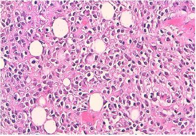 Figure 3: Hematoxylin-eosin-saffron stain x 250: Isomorphic small cells with focal lipomatous differentiation.