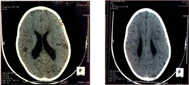 Figure 5: FM, TDM cérébrale sans injection de produit de contraste, coupe axiale