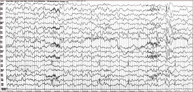 Figure 8: NNF, 1an 5mois, EEG 2 de sommeil avec une amplitude à 100 microvolts/cm (22/08/14)