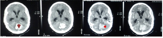 Figure 1: Pre- and post-contrast computed tomography (CT) showing a well circumscribed, hemorrhagic lesion in the posterior fossa (arrow head) with minimal perilesionaloedema and mild contrast enhancement (star). There is associated third and lateral ventriculomegaly