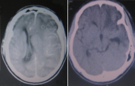 Fig. 2 : Cas N° 2 : Homme, 29 ans, Score de Glasgow initial à 7, engagement temporal : le scanner cérébral montre le rétablissement de la ligne médiane (à droite), déviée avant la craniectomie (à gauche).