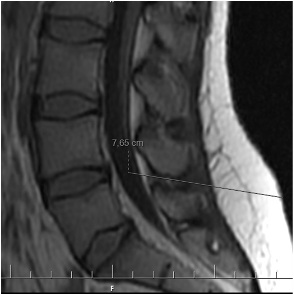 Figure 3: mesure de la profondeur du canal vertébral sur une coupe sagittale médiane du rachis lombaire en pondération T1.