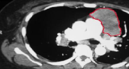 Fig 1 CT Scan of  chest showing enlarged thymus gland (Thymoma)