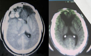 Fig. 1 : cas N°9 Homme, 36 ans, score de Glasgow initial à 6, engagement sous-falcoriel : le scanner cérébral montre le rétablissement de ligne médiane (à droite), déviée  avant la craniectomie (à gauche).