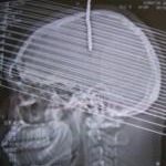 Figure 1: cranial computerized tomography scans brain (sagittal)