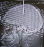 Figure 1: cranial computerized tomography scans brain (sagittal)