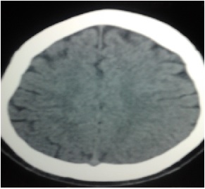 Figure 1 : Scanner cérébral avant thrombolyse, normal (Score ASPECT 10/10)