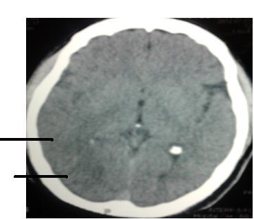 Figure 2 : Scanner cérébral de 24h après thrombolyse : différentiation cortico-sous-corticale et légère hypodensité  dans le territoire postérieur de l'artère cérébrale moyenne