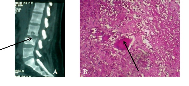 Figures 1 : (A)Scanner du rachis lombaire en reconstruction sagittale mettant en evidence une spondylodiscite L3-L4. 