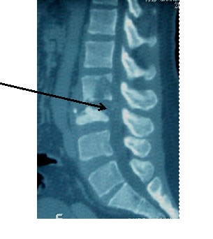 Figure 2 : scanner du rachis lombo sacré avec reconstruction sagittale mettant en évidence une spondylodiscite L2-L3 (flèche).