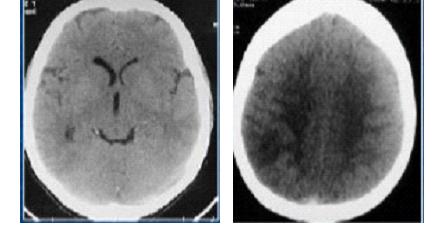 Figure 1 : TDM en coupes axiale sans injection : Œdème cérébral diffus
