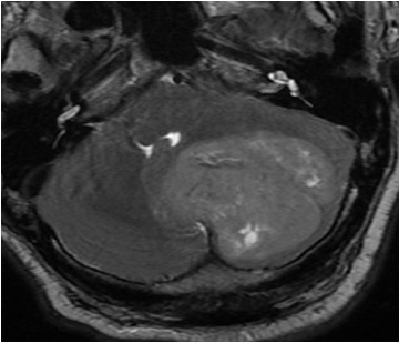 Figure 1: T2-Weighted MRI of cerebellar tumour.