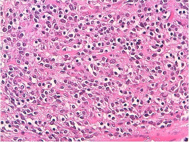 Figure 2: Hematoxylin-eosin-saffron stain x 250: tumour cells showing a round nuclei with a clear cytoplasm resembling neoplastic oligodendrocytes.