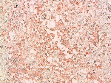 Figure 5: Immunoreactivity with anti-synaptophysin, DAB x 100. Small tumour cells express neuronal marker.