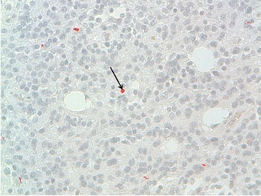 Figure 7: Immunoreactivity with anti-desmin, DAB x 100. Positivity of some tumor cells, indicating an myogenic differentiation. (arrows)