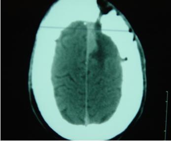 Figure 2 : scanner post-opératoire 3 ans après intervention méningiome de la faux 1/3 moyen /résidu tumoral non évolutif
