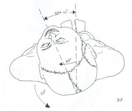 Fig 1 - Volet fronto-temporal. Position de la tête