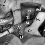 Figure 2 : Vue subfrontale après ablation des lobes frontaux / Subfrontal view after frontal lobe