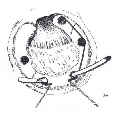 Fig 6 - Volet fronto-temporal. Incision musculaire. Taille à la scie de Gigli.