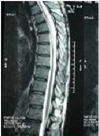 Figure 1: IRM médullaire pondérée en séquence T2, montre une atrophie médullaire dorsale. 